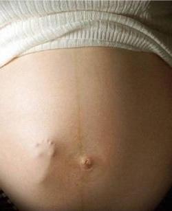 Striben på underlivet under graviditeten: hvorfor det ser ud og hvor det forsvinder efter fødslen
